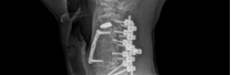 경추 협착증 진단 X-ray 사진